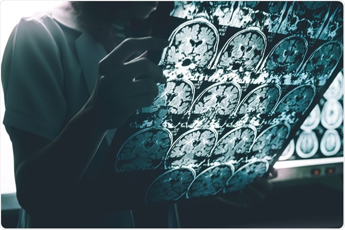 Alzheimer's disease on MRI. Image Credit: Atthapon Raksthaput / Shutterstock